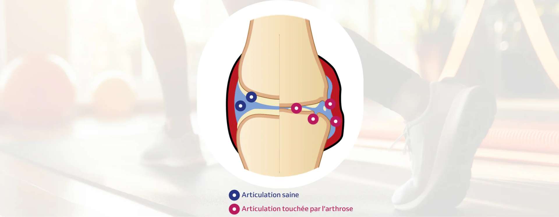 Schéma comparatif d’une articulation du genou saine et d’une articulation touchée par l’arthrose, illustrant les zones d’altération.