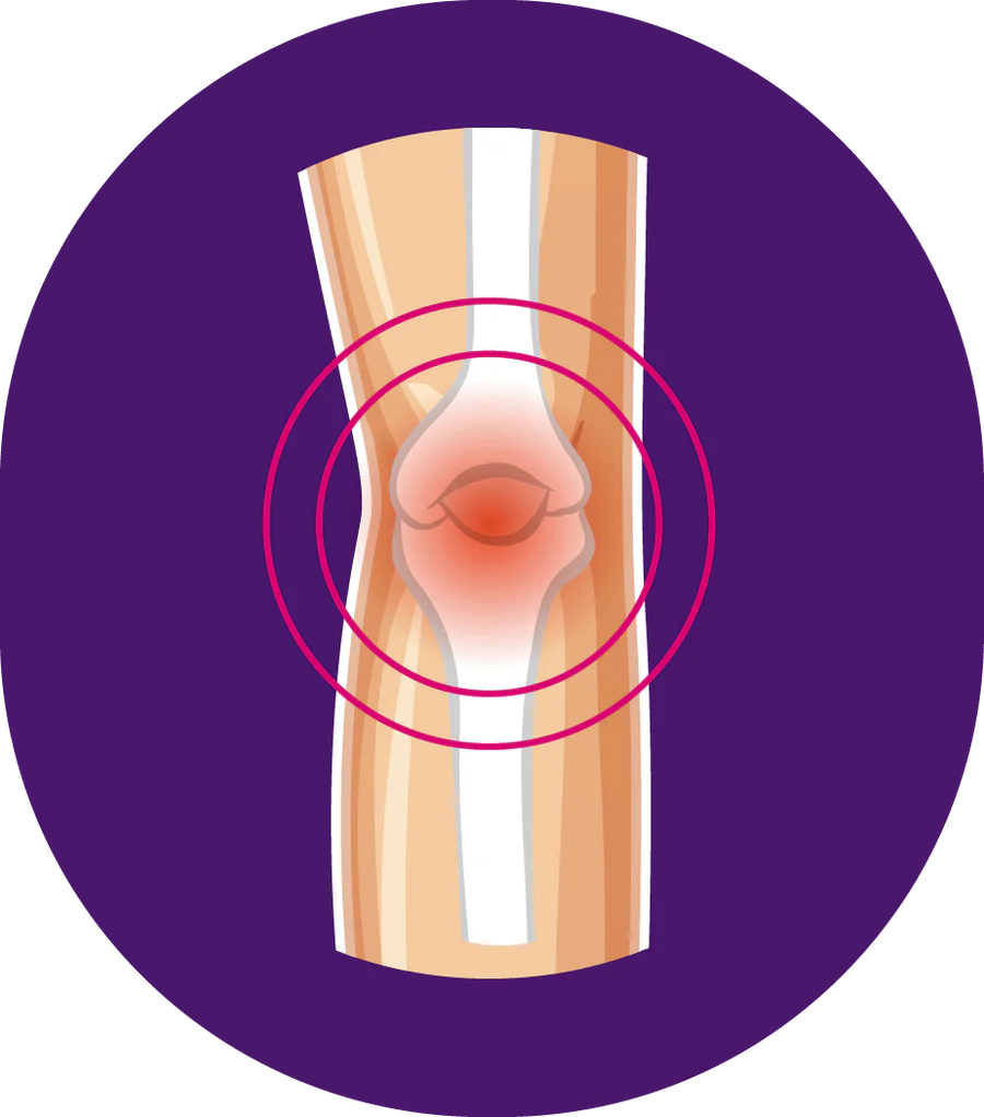 Schéma médical illustrant une articulation du genou avec inflammation, typique de l’arthrose.