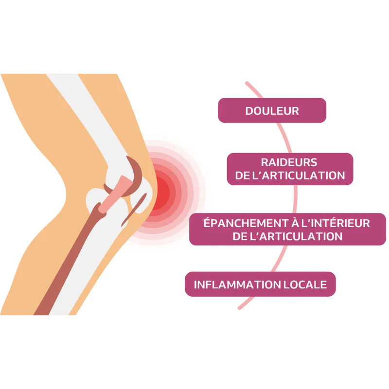L’arthrose et ses principales manifestations¹⁻²